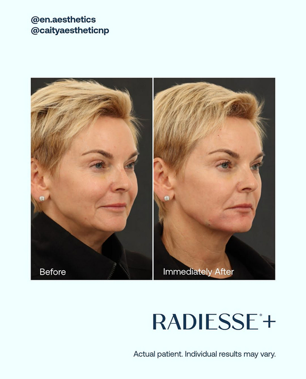 Radiesse
